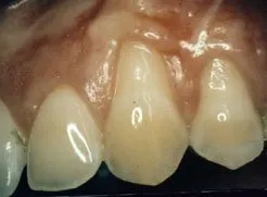 A close up image of a patient's teeth and gums before gum grafting