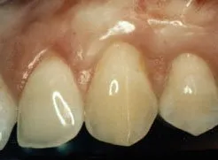 A close up image of a patient's teeth and gums after gum grafting