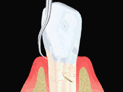 An animated illustration showing the process of root planing to allow gum to heal