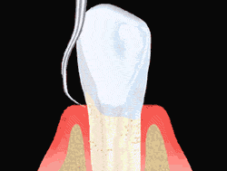 An animated illustration showing the process of scaling to clean under gum line